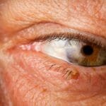 Close-up of an older man's eye featuring a prominent brown eyelid wart.