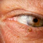 Close-up of an older man's eye featuring a prominent brown eyelid wart.