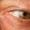 Close-up of an older man's eye featuring a prominent brown eyelid wart.