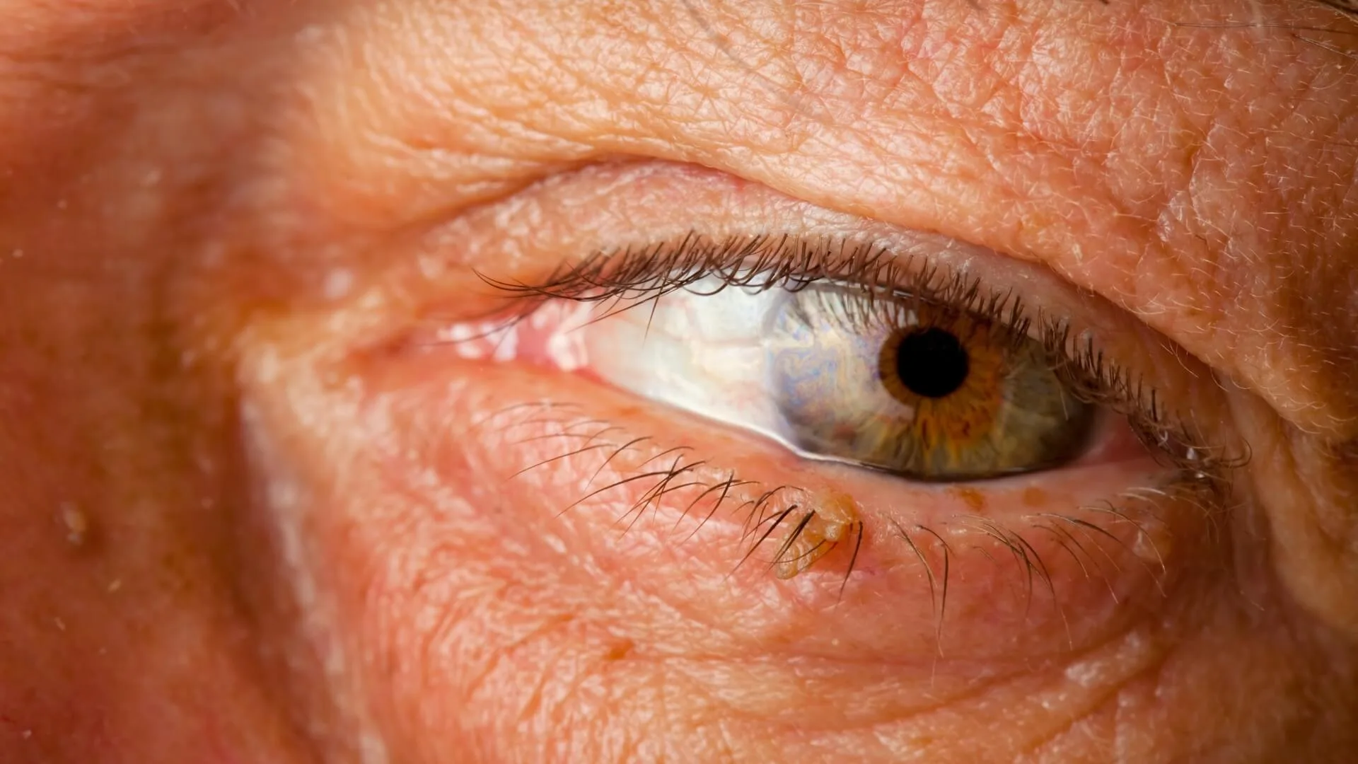Close-up of an older man's eye featuring a prominent brown eyelid wart.