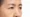 Droopy Eyes