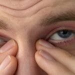 Epiphora (Watery Eyes)