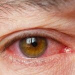 Vascular accidents of the eye