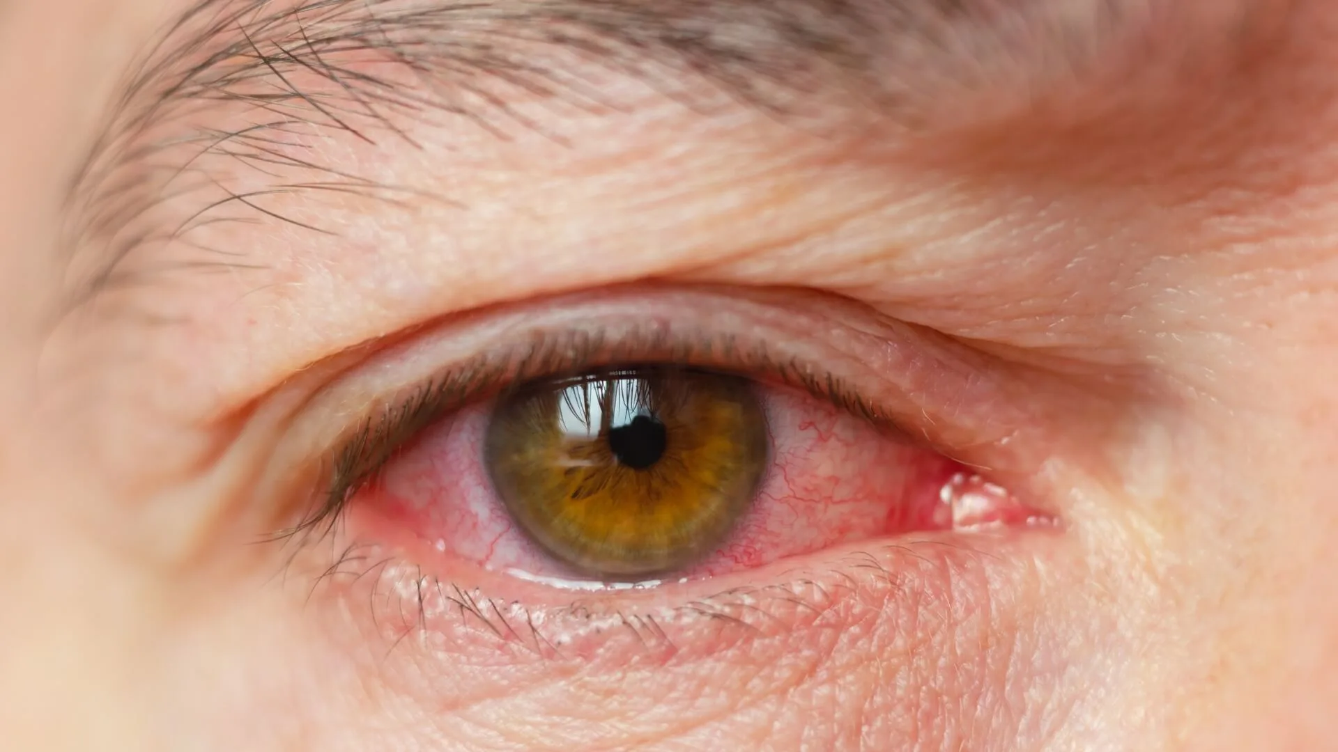Vascular accidents of the eye