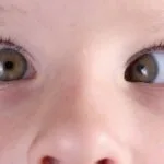 Squint in Children