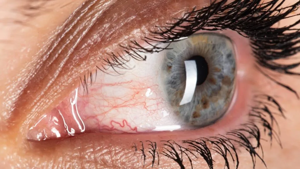 Eyelid Wart