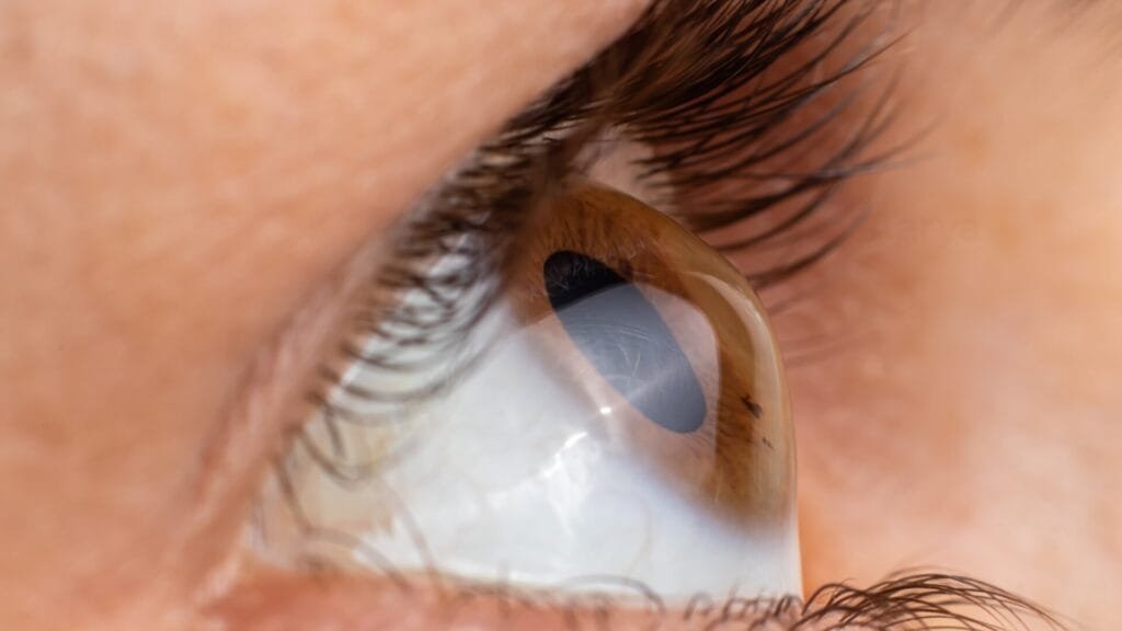 Keratoconus