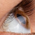 Keratoconus