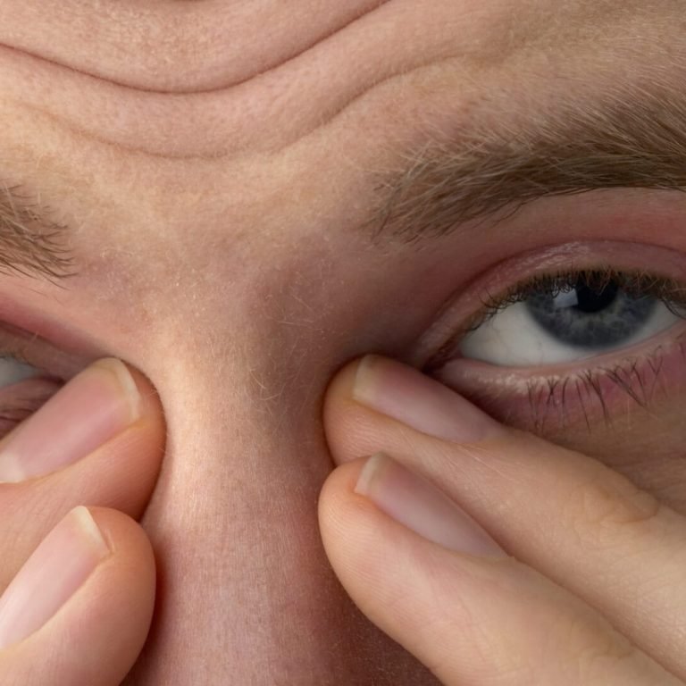 Epiphora (Watery Eyes)