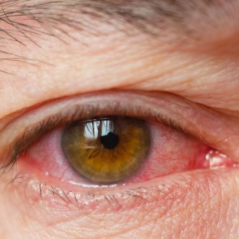 Vascular accidents of the eye
